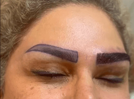 Eyebrow transplant in Shiraz