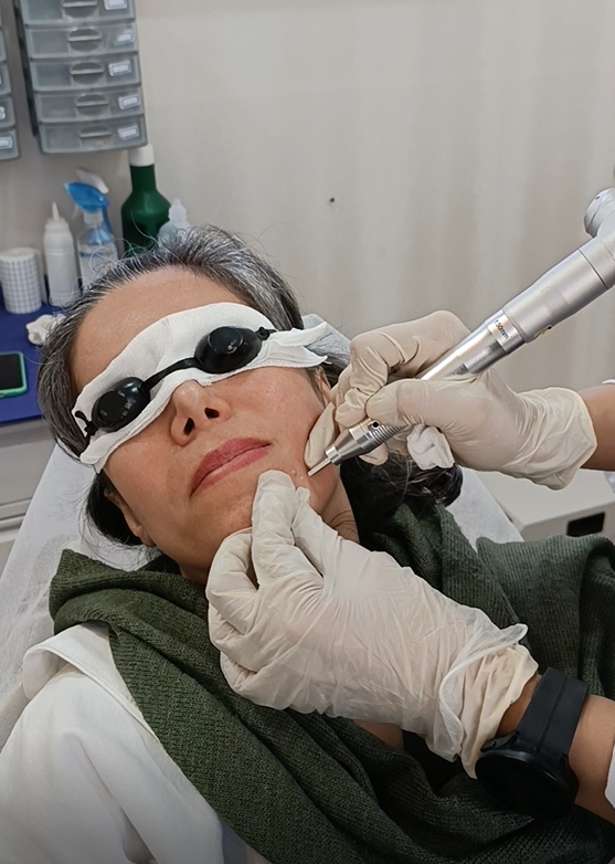 Mole removal with CO2 laser: an effective solution to remove moles in Parsamehr clinic