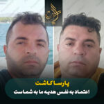 کاشت مو