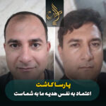 کاشت مو