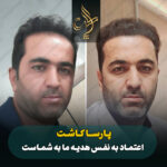 کاشت مو