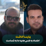 کاشت مو