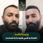کاشت مو