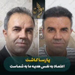 کاشت مو