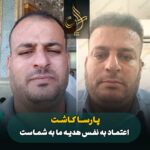 کاشت مو
