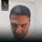کاشت مو