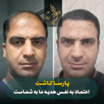 کاشت مو