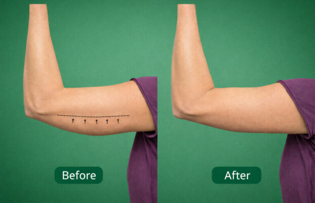 عملية شد الذراع بدون شفط الدهون