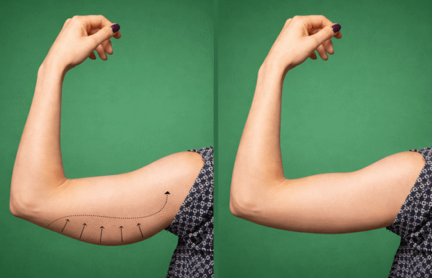 عملية شد الذراع مع شفط الدهون