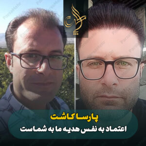 نمونه کار کاشت مو شیراز کلینیک پارسامهر