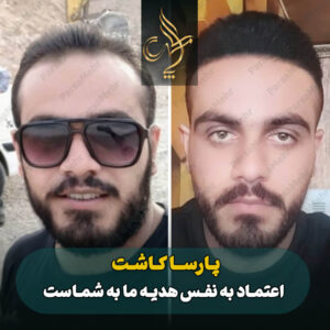 نمونه کار کاشت مو شیراز کلینیک پارسامهر