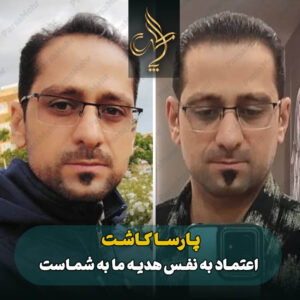 نمونه کار کاشت مو شیراز کلینیک پارسامهر