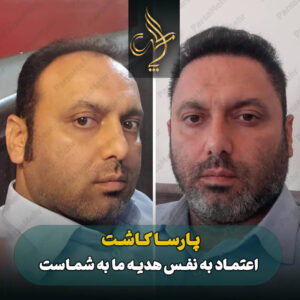 نمونه کار کاشت مو شیراز کلینیک پارسامهر