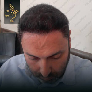 نمونه کار کاشت مو شیراز کلینیک پارسامهر