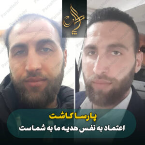 نمونه کار کاشت مو شیراز کلینیک پارسامهر