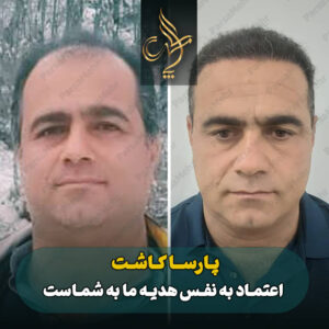 نمونه کار کاشت مو شیراز کلینیک پارسامهر