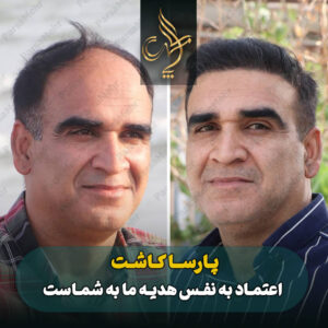 نمونه کار کاشت مو شیراز کلینیک پارسامهر