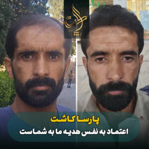 نمونه کار کاشت مو شیراز کلینیک پارسامهر