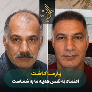 نمونه کار کاشت مو شیراز کلینیک پارسامهر
