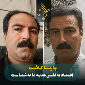 نمونه کار کاشت مو شیراز کلینیک پارسامهر
