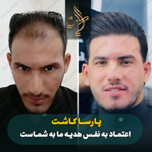 نمونه کار کاشت مو شیراز کلینیک پارسامهر