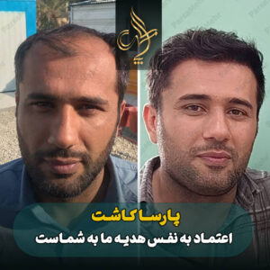 نمونه کار کاشت مو شیراز کلینیک پارسامهر