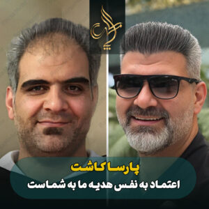 نمونه کار کاشت مو شیراز کلینیک پارسامهر