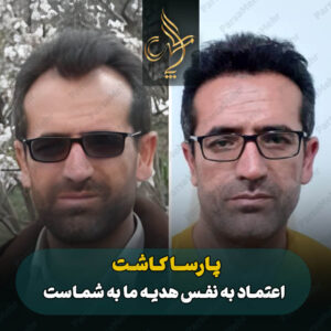 نمونه کار کاشت مو شیراز کلینیک پارسامهر