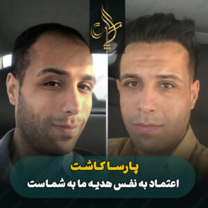 نمونه کار کاشت مو شیراز کلینیک پارسامهر