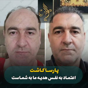 نمونه کار کاشت مو شیراز کلینیک پارسامهر