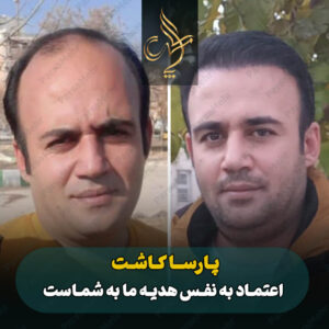نمونه کار کاشت مو شیراز کلینیک پارسامهر