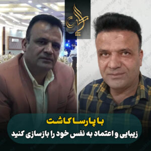 نمونه کار کاشت مو شیراز کلینیک پارسامهر
