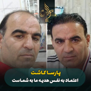 نمونه کار کاشت مو شیراز کلینیک پارسامهر