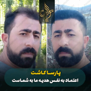 نمونه کار کاشت مو شیراز کلینیک پارسامهر