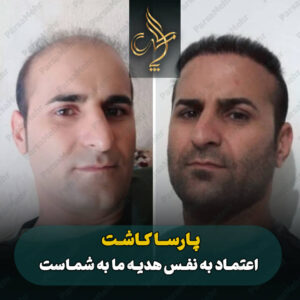 نمونه کار کاشت مو شیراز کلینیک پارسامهر