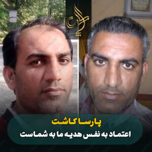 نمونه کار کاشت مو شیراز کلینیک پارسامهر