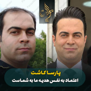 نمونه کار کاشت مو شیراز کلینیک پارسامهر