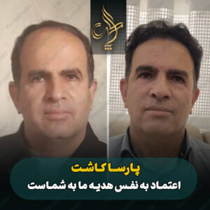 نمونه کار کاشت مو شیراز کلینیک پارسامهر