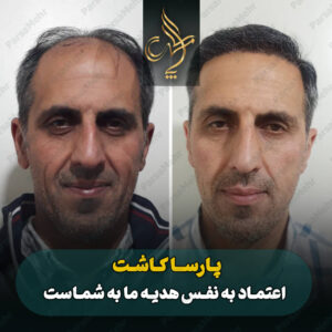 نمونه کار کاشت مو شیراز کلینیک پارسامهر