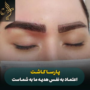 نمونه کار کاشت مو پارسامهر شیراز