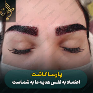 نمونه کار کاشت ابرو شیراز کلینیک پارسامهر