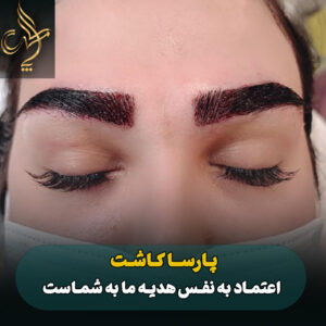 نمونه کار کاشت مو پارسامهر شیراز
