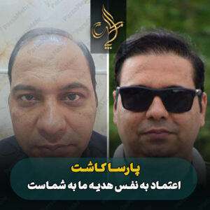 نمونه کار کاشت مو شیراز کلینیک پارسامهر