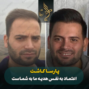 نمونه کار کاشت مو شیراز کلینیک پارسامهر