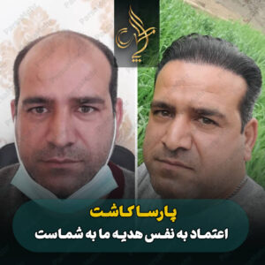 نمونه کار کاشت مو شیراز کلینیک پارسامهر