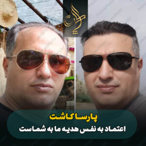 نمونه کار کاشت مو شیراز کلینیک پارسامهر