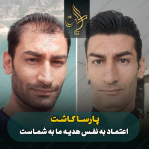 نمونه کار کاشت مو شیراز کلینیک پارسامهر