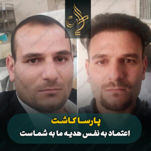 نمونه کار کاشت مو شیراز کلینیک پارسامهر