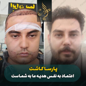 نمونه کار کاشت مو شیراز کلینیک پارسامهر