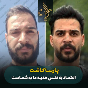 نمونه کار کاشت مو شیراز کلینیک پارسامهر